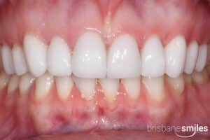 Porcelain Veneers Inside the Mouth