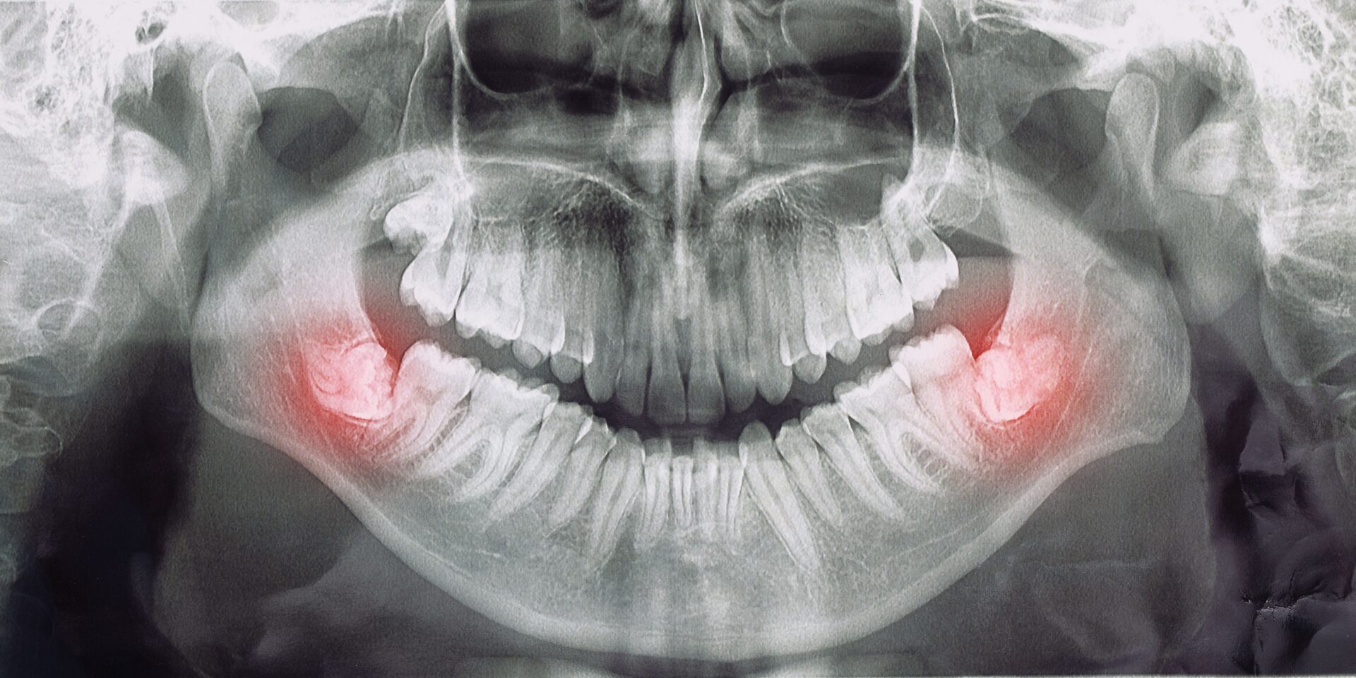 X-ray of two back wisdom teeth for Brisbane wisdom teeth removal