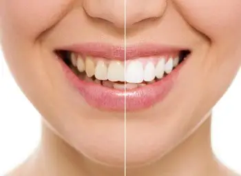 cosmetic dental consultation