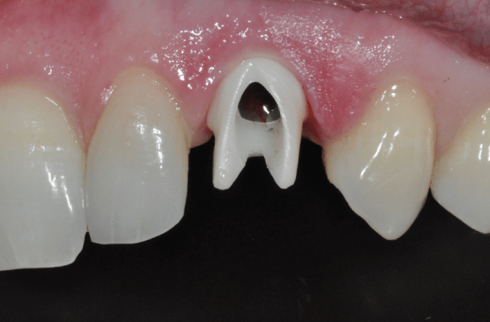 Zirconia Abutment on Dental Implant
