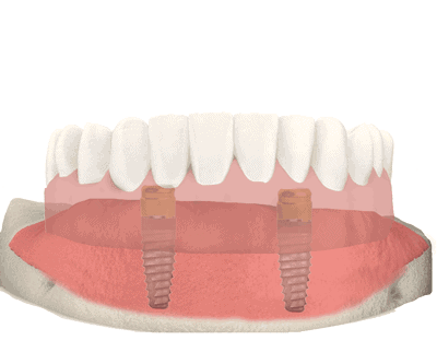 dental implant dneture