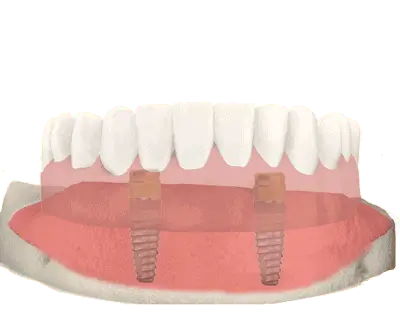 dental implant dneture