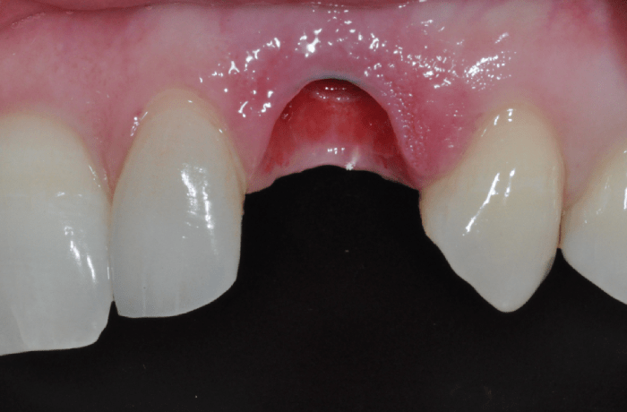 Missing tooth with Dental Implant unrestored