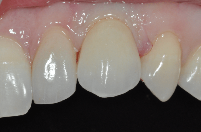 Porcelain Crown on Dental Implant
