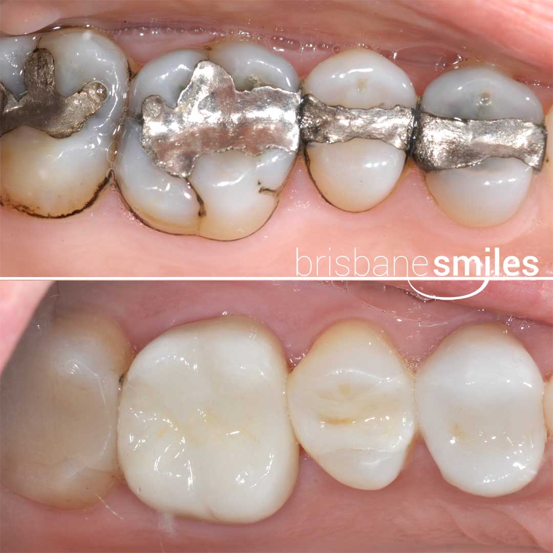 repalcing old amalgam fillings with porcelain onlays, porcelain crowns and white resin fillings