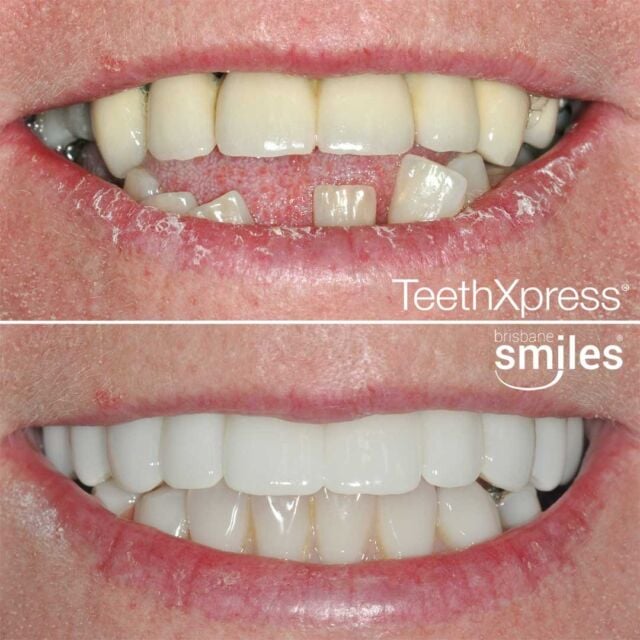 dentalimplants teethxpress biohorizons aox #brisbanesmiles missingteeth upper lower upperandlower