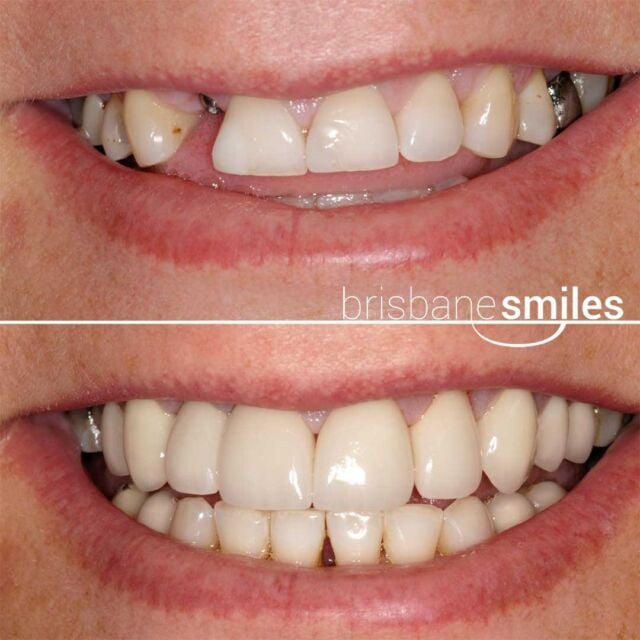 dentalimplant missingteeth porcelaincrowns #brisbanesmiles