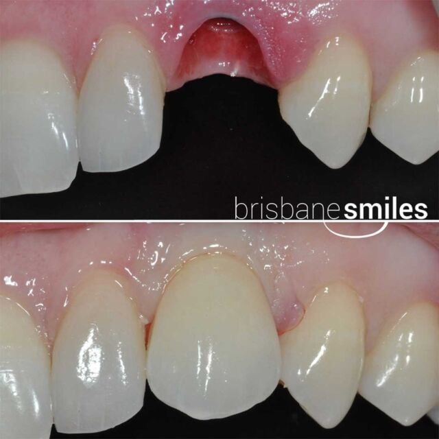 dentalimplants singletooth missingteeth #brisbanesmiles