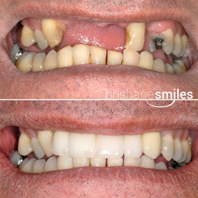 dentalimplants implantbridge zirconiabridge 5missingteeth missingteeth #brisbanesmiles