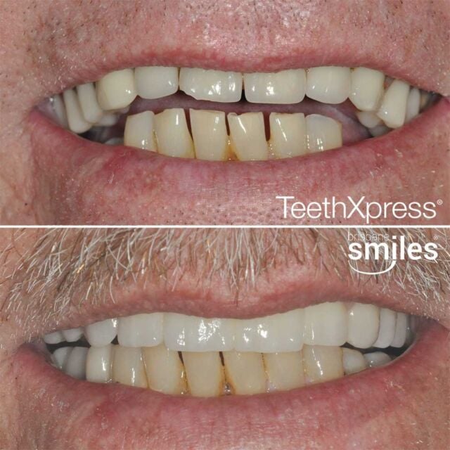dentalimplants teethxpress biohorizons aox #brisbanesmiles missingteeth