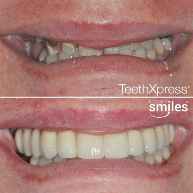 dentalimplants grossdecay teethxpress biohorizons aox #brisbanesmiles missingteeth upper