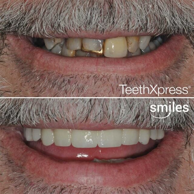 dentalimplants teethxpress biohorizons aox #brisbanesmiles missingteeth upper