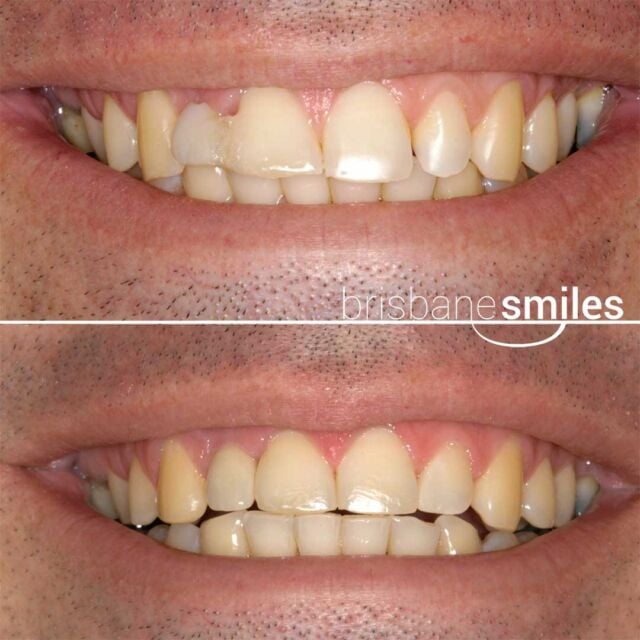 dentalimplants missingteeth lateralincisor singleimplant #brisbanesmiles