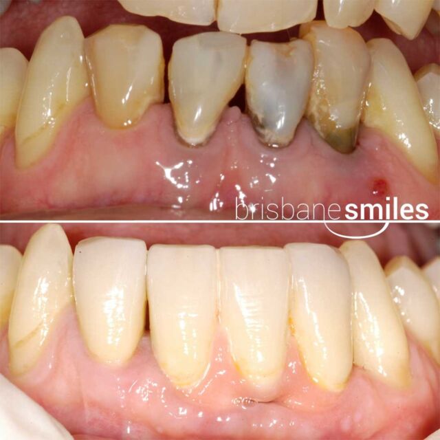 dentalimplants implantbridge 3teethreplacement #brisbanesmiles
