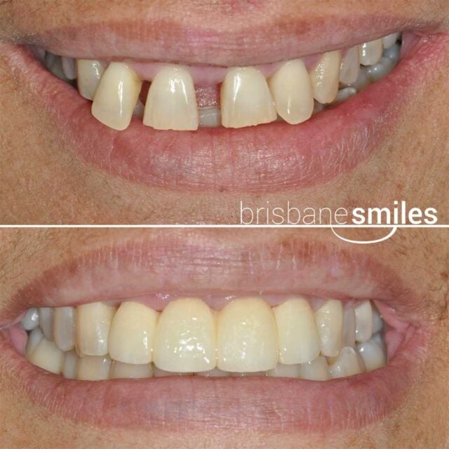 dentalimplants replace4teeth #brisbanesmiles missingteeth