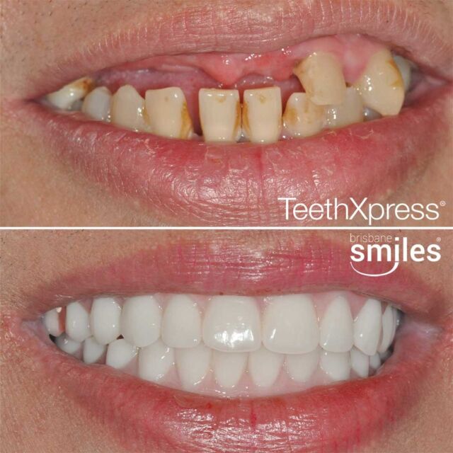 dentalimplants teethxpress biohorizons aox #brisbanesmiles missingteeth upperandlower upper lower pmma
