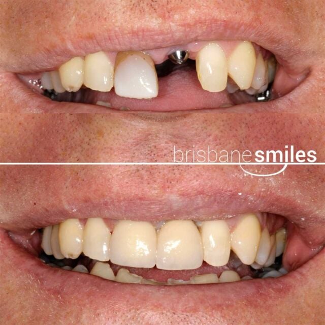 dentalimplants missingteeth #brisbanesmiles