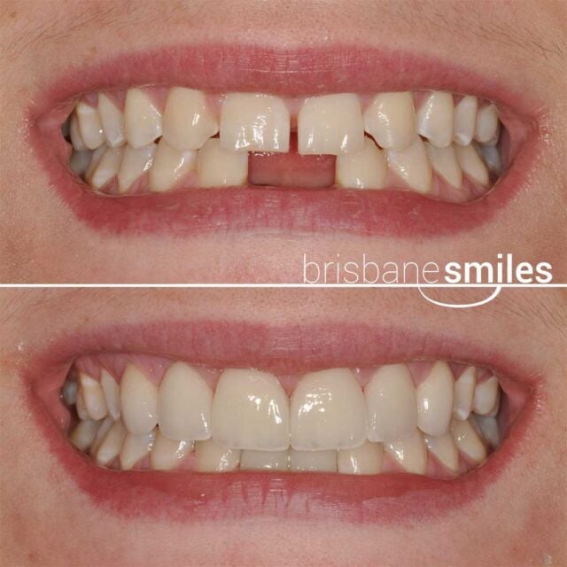 dentalimplants missingteeth smilemakeover spacedteeth #brisbanesmiles