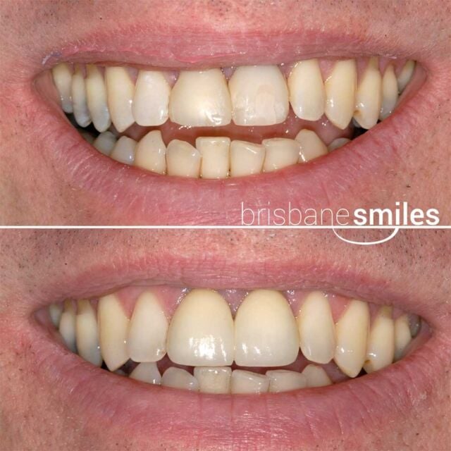 dentalimplants singlelateralincisorreplacement #brisbanesmiles missingteeth