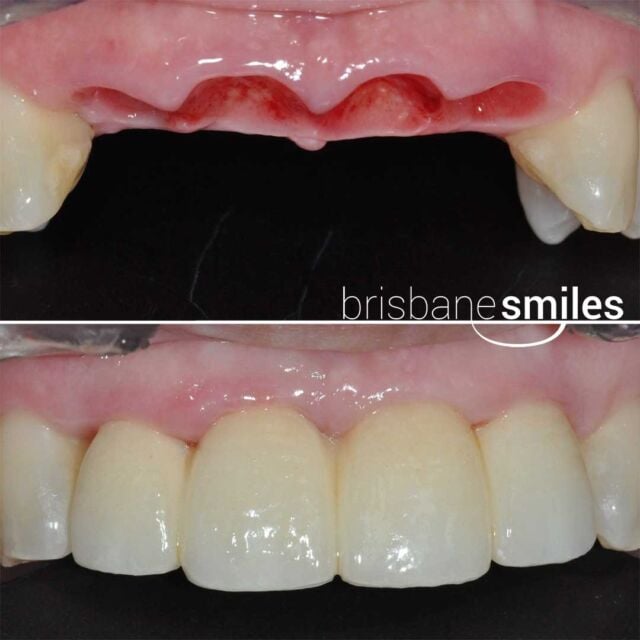 dentalimplants missingteeth 4teethimplants #brisbanesmiles