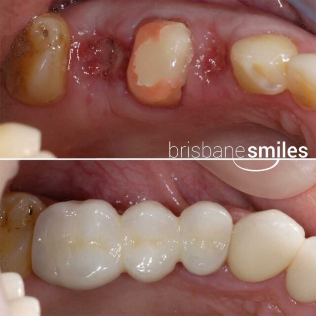 dentalimplants implantbridge 3teeth #brisbanesmiles missingteeth