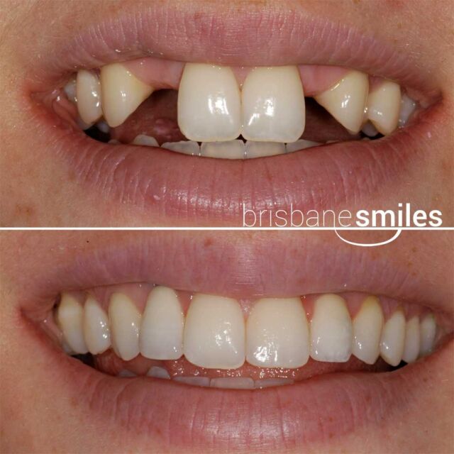 dentalimplant missingteeth #brisbanesmiles