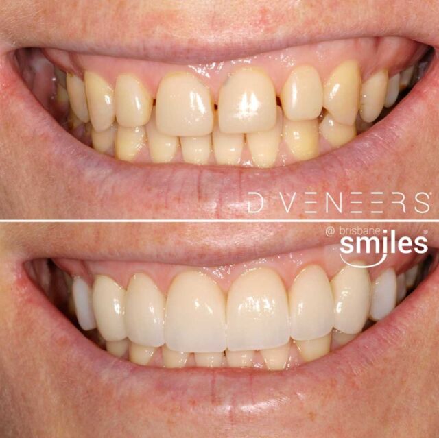 Closing the gap to a confident smile! 😁✨ 

Look at this smile makeover from spaced teeth to a confident smile with porcelain veneers.

Ready to enhance your own smile? Schedule a consultation at 3870 3333 or book online via our link in bio! 

#BrisbaneSmiles #SmileMakeover #BeforeAndAfter #PorcelainVeneers #DVeneers

⚠️ Actual patient photo. Individual results will vary. All minor and major dental treatments have risks. Please seek the advice of a qualified healthcare professional before proceeding.