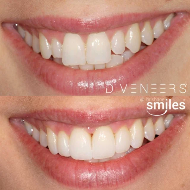 Another smile transformation to brighten your day! ✨

Look at this stunning before and after of Porcelain Veneers and Teeth Whitening 😄

Ready to start your Smile Makeover journey? Contact us today at 3870 3333 or via the link in our bio 🦷

⚠️ Actual patient photo. Individual cases will vary. For all minor and major dental treatments, please seek the opinion of a dental professional before proceeding.

#brisbanesmiles #brisbanesmilescases #smilemakeover #dveneers