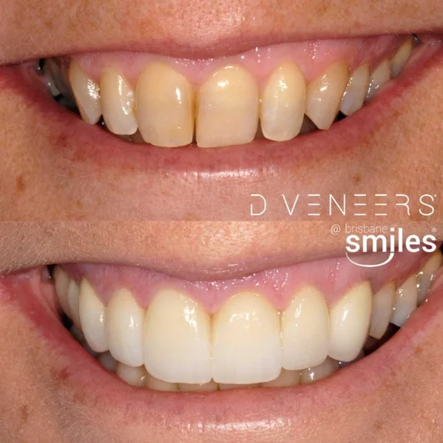 Look at this stunning before and after of a smile transformation! ✨

With Porcelain Veneers and expert care, we've erased discolouration and revitalised this smile 😄

Start your journey today! Book your appointment via the link in our bio or call our team on 3870 3333 💙

⚠️ Actual patient photo. Individual cases will vary. For all minor and major dental treatments, please seek the opinion of a dental professional before proceeding.

#brisbanesmiles #brisbanedentist #dentist