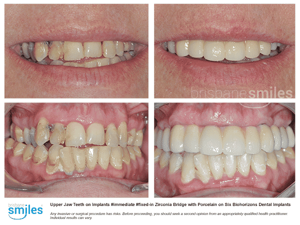 replacing all upper teeth with dental implants and zirconia bridge in brisbane