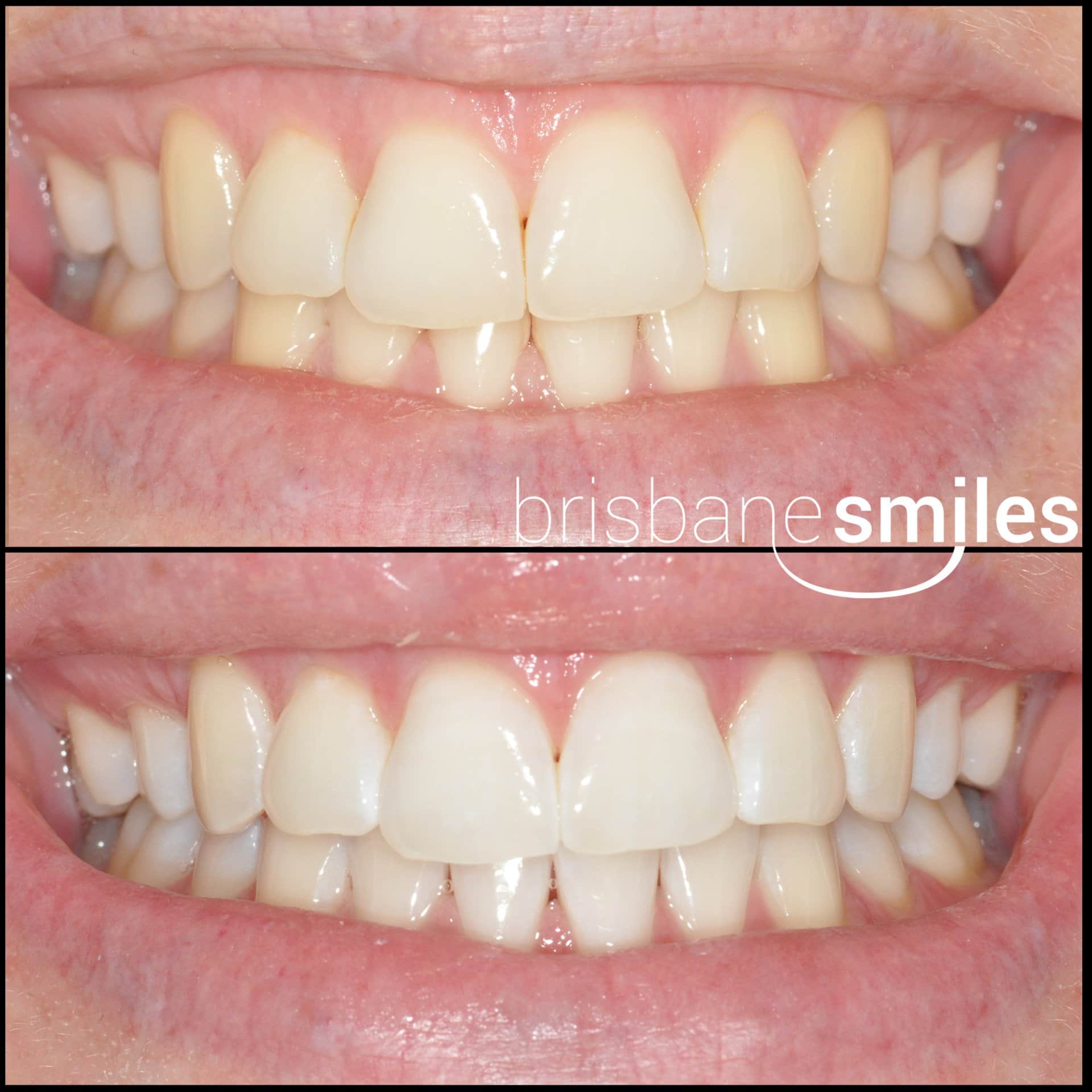 zoom teeth whitening before and after