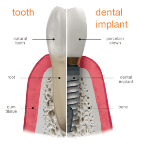 diagram of a dental implant and a tooth