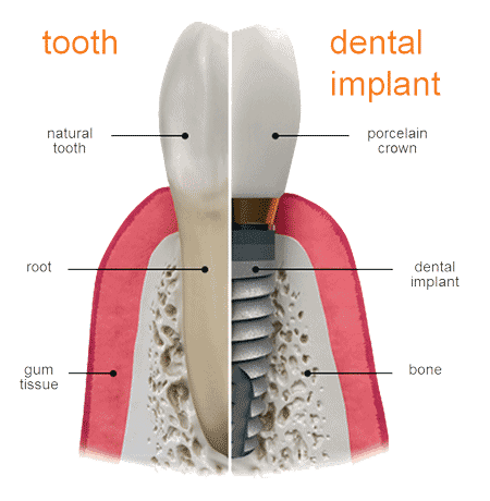 diagram of a dental implant and a tooth