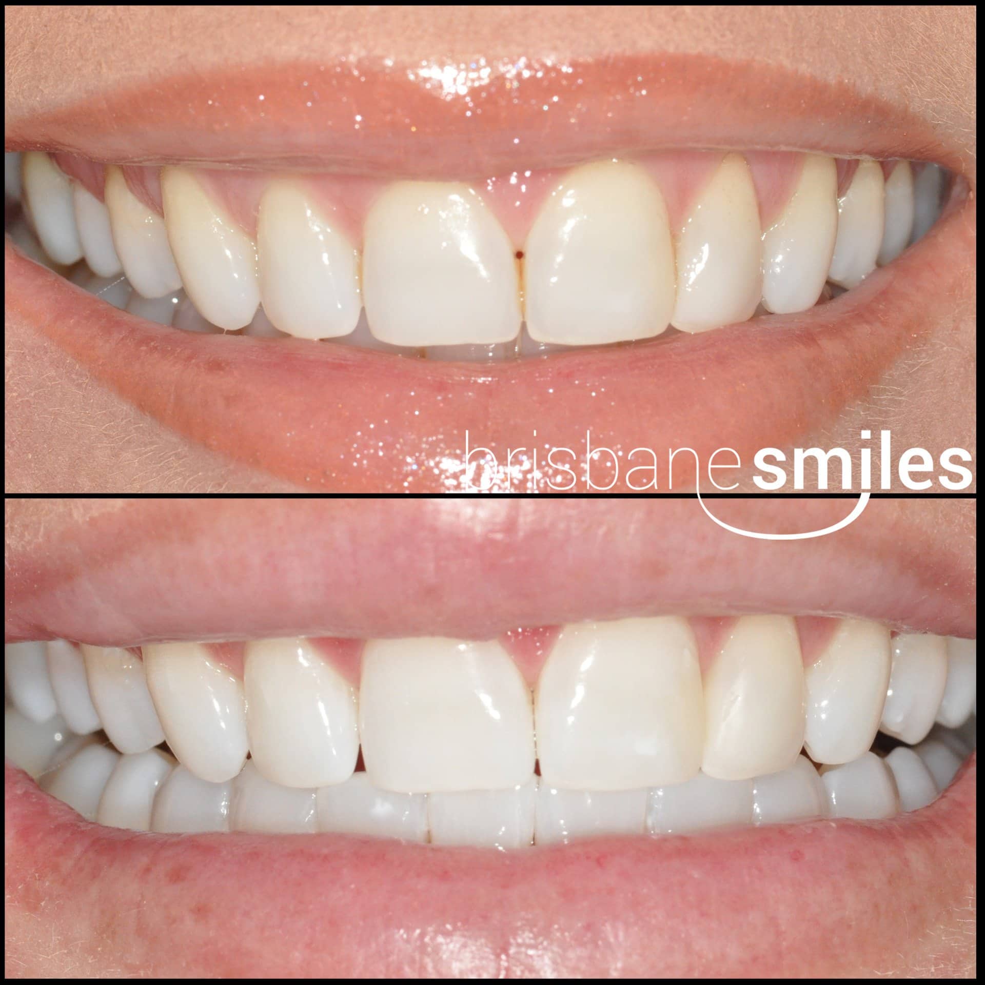 zoom teeth whitening photos before and after